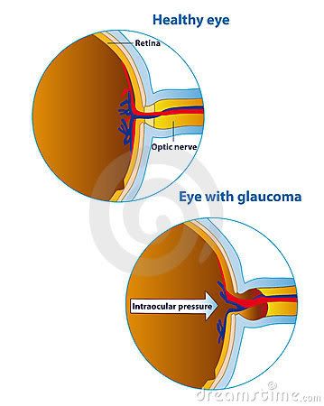 Olho com e sem glaucoma