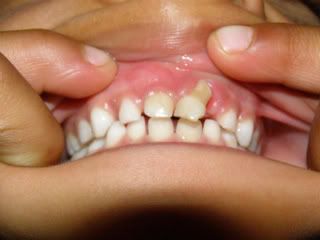 Tooth Injury