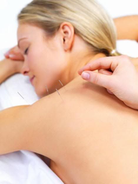 Acupuntura para relaxamento